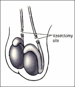 Vasectomy picture
